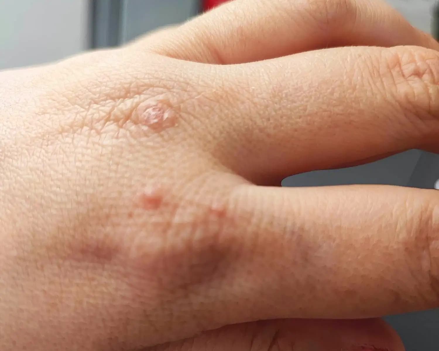 Po upałach Polacy masowo szukają dermatologów. Zauważyłeś swędzące grudki? Na wizytę poczekasz nawet 686 dni